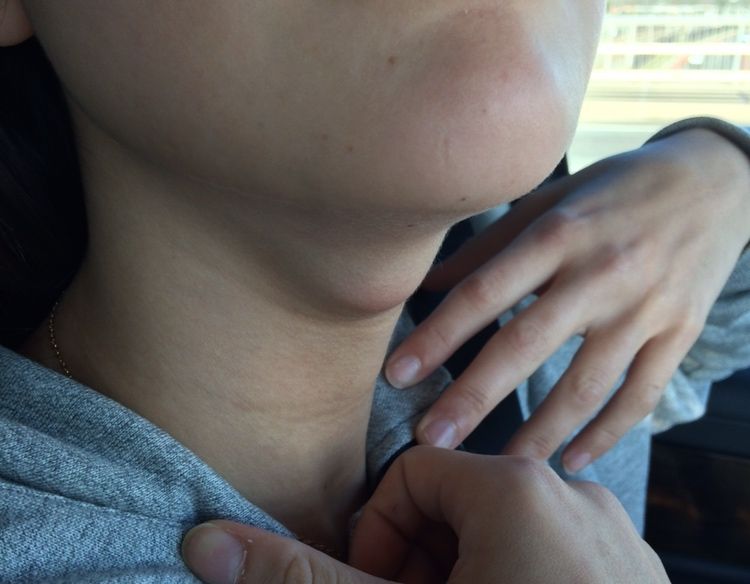 File:Thyroglossal Cyst.jpg