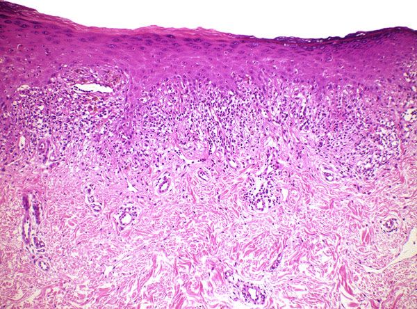 File:Histopathology of lichenoid drug reaction.jpg