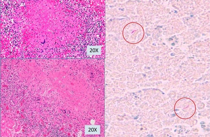 File:Microscopy of tuberculous micronodules.jpg