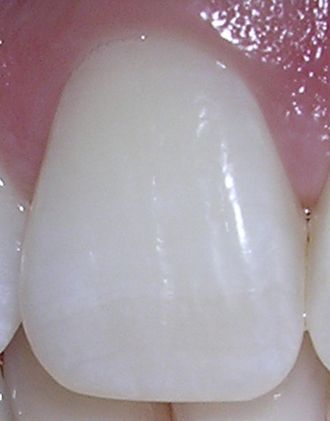 File:06-10-06rightcentralincisor.jpg