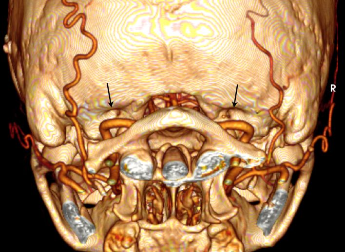 File:Condylar canal.jpg