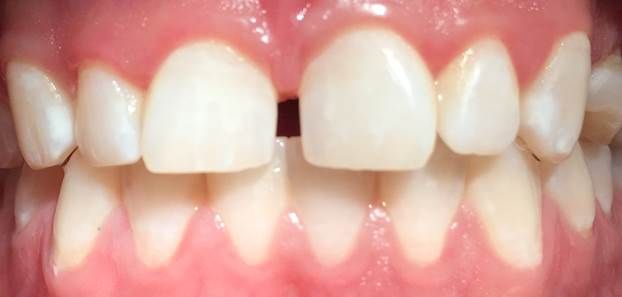 File:Loss of tooth characteristics.jpg