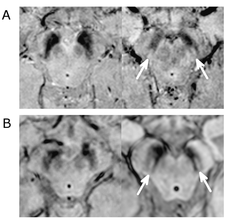 File:Parkinson vs non parkinson.png