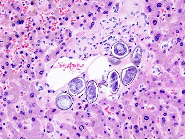 File:Schistosoma japonicum (3) histopathology.JPG