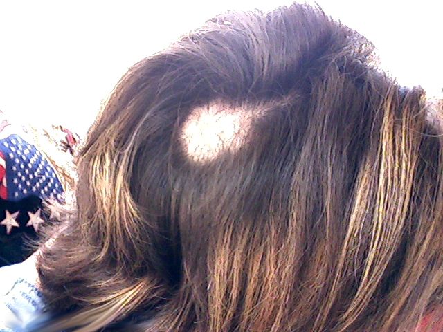 File:Trichotillomania 2.jpg