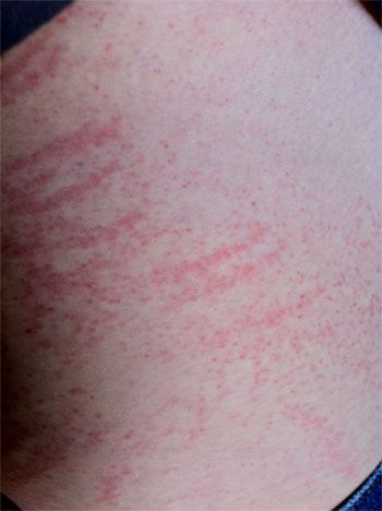 File:ContactDermatitis.jpg