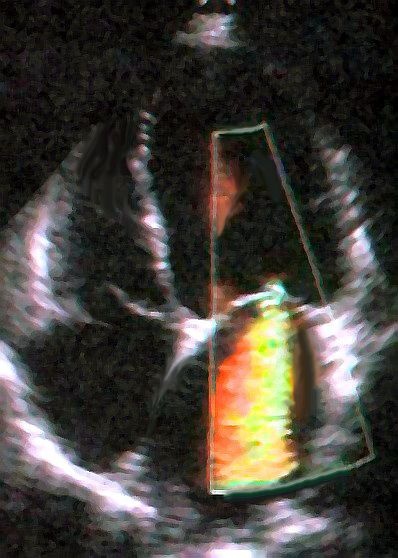 File:Mitral regurgitation echo 4chamber.jpg