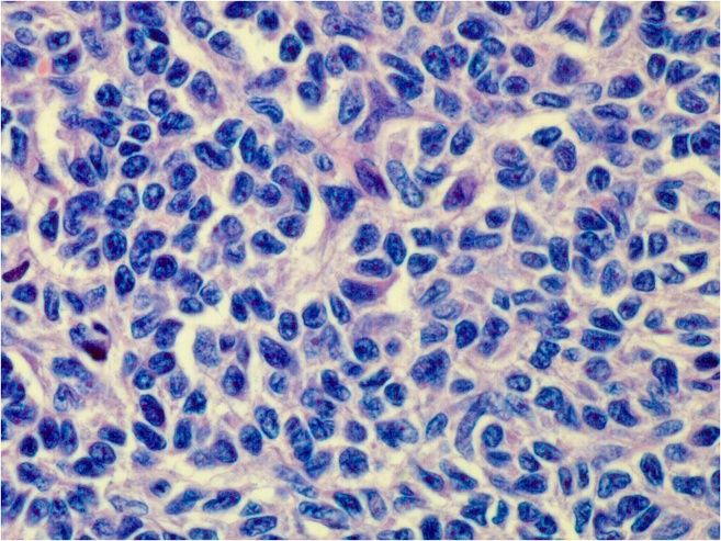 File:Histopathology of adult granulosa cell tumor.jpg