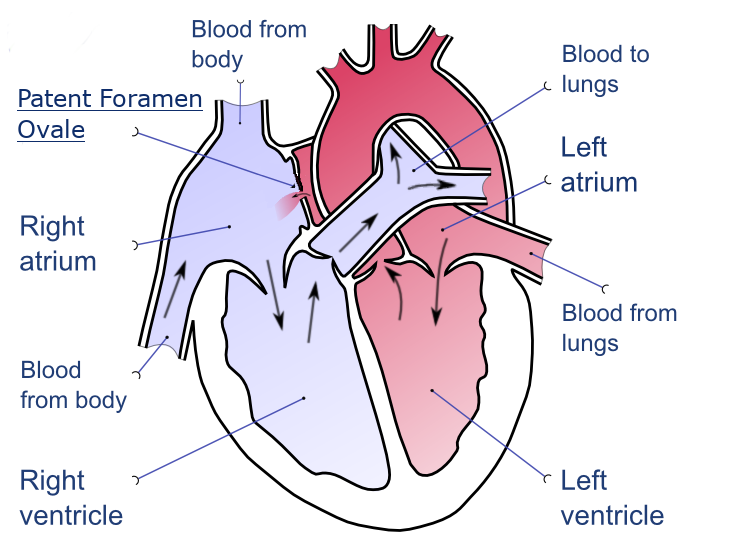 File:Patent-foramen-ovale-en.png