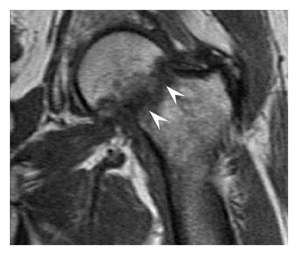 File:T1 MRI of subcapital insufficiency fracture.jpg