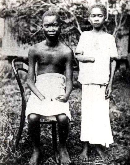 File:Amputated Congolese youth.jpg