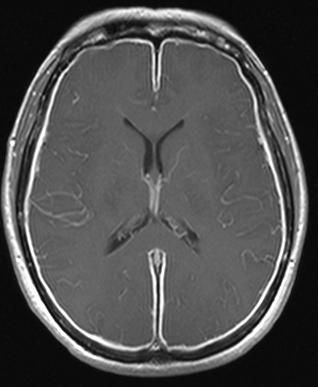 File:Meningitis-MRI.JPG