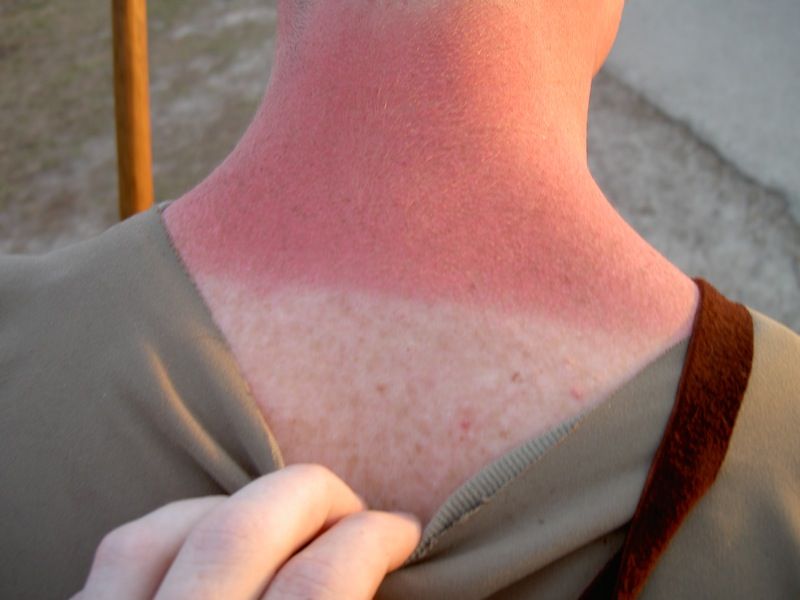 File:Sunburn Treatment Practices.jpg