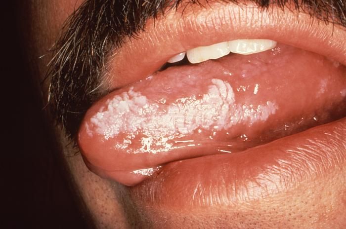 File:Leukoplakiaaitor.jpg