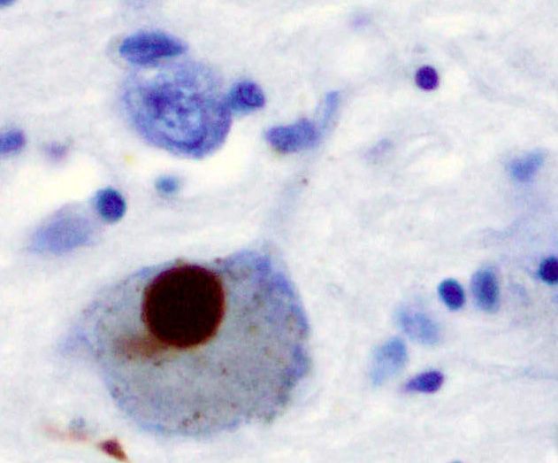 File:Lewy Body alphaSynuclein.jpg