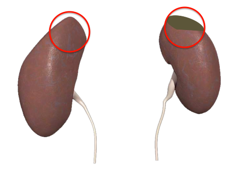 File:Tumor on the Kidney.png