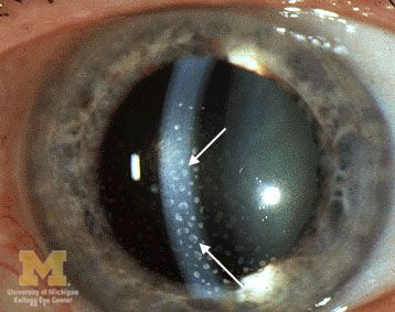 File:Keratic-precipitates.jpg