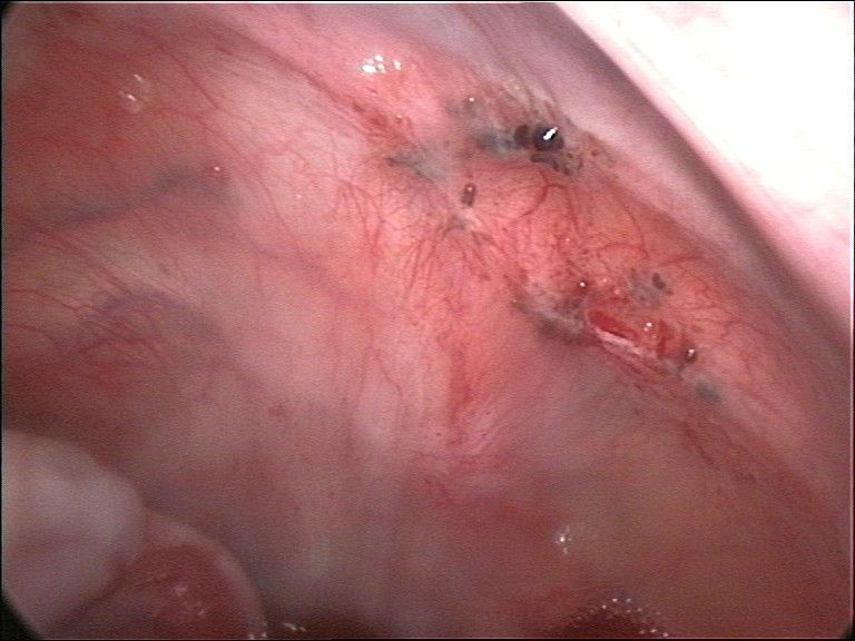 File:Peritoneal endometriosis.jpg