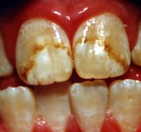 File:Bellingham fluorosis 3.jpg