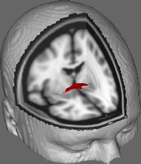 File:DTI of the Anterior Commissure.jpg