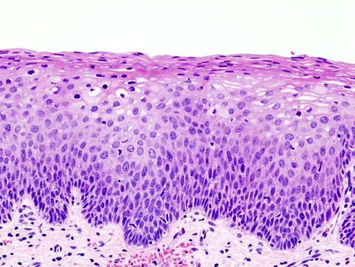 File:Cervical intraepithelial neoplasia (3) CIN2.jpg