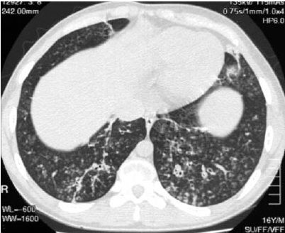 File:HRCT scans of diffuse panbronchiolitisCropped.jpg