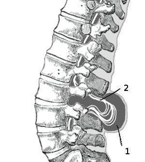 File:Meningomyelocele diagram.jpg