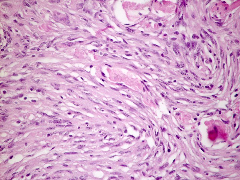 File:Meningioma fibromatous variant.jpg