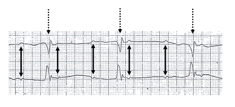 File:3rd degree heart block.PNG