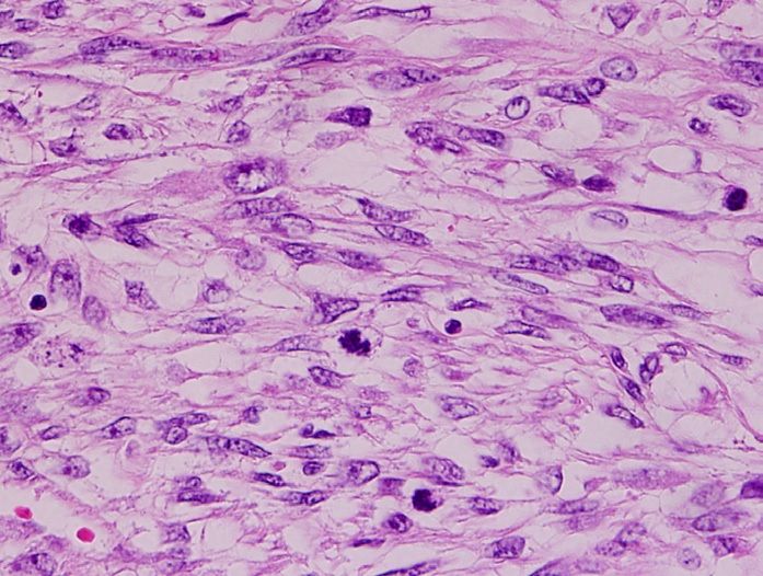 File:Histopathology of leiomyosarcoma.jpg