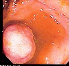 File:SB polyp.jpg