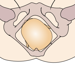 File:Cephalic presentation - left occipito-posterior.png