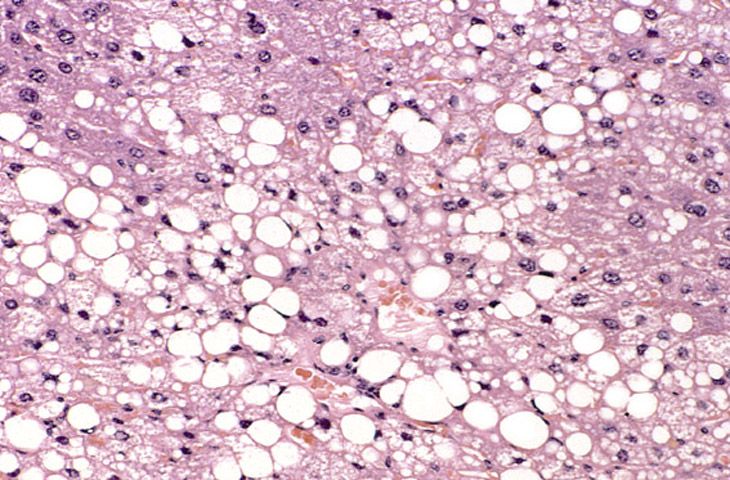 File:Liver steatosis fatty change.jpg