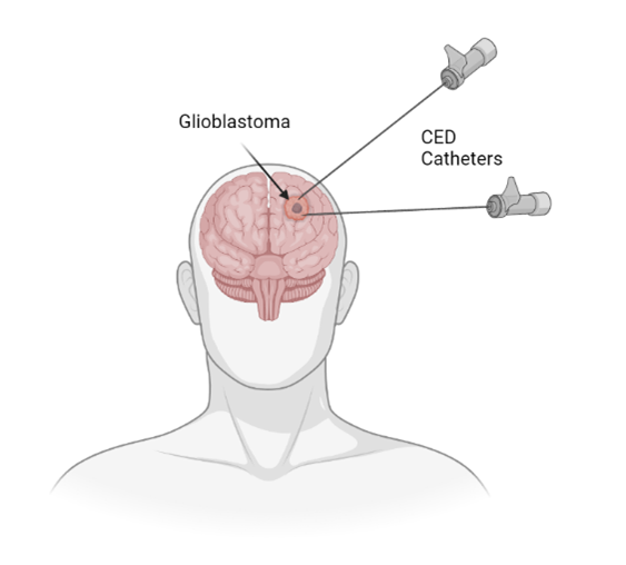 File:Glioblastoma Treatment Using CED.png