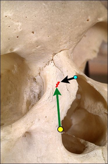 File:RhinoplastySkullOsteo.jpg