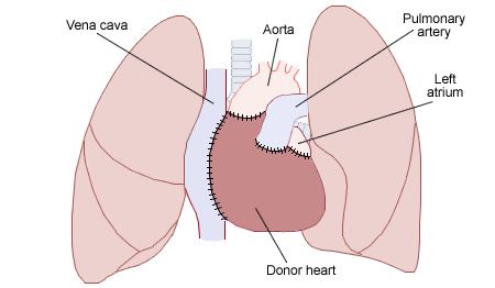 File:Heart transplant.jpg