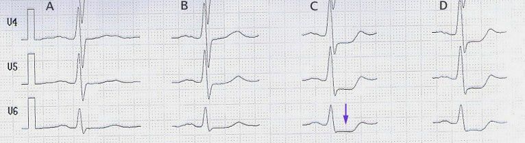 File:StressECG STDepression.jpg