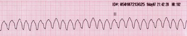 File:Lead II rhythm ventricular tachycardia Vtach VT.JPG