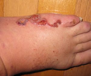 File:Cutaneous-larva-migrans-foot.jpg