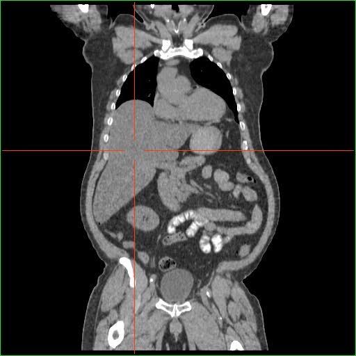 File:Hepatomegaly - CT single angle.jpg