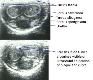 File:Peyronie's Disease Ultrasound.jpg