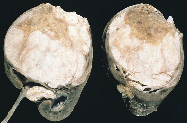 File:Wilms tumor.jpg