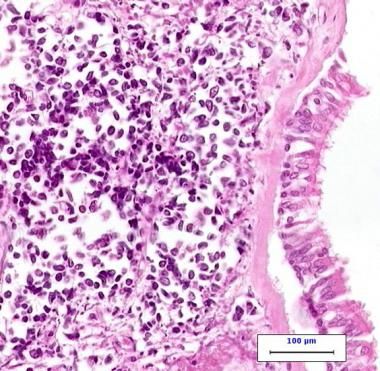 File:Small cell lung carcinoma.jpg