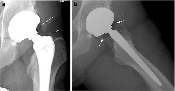 File:X-ray of hip prosthesis with pneumarthrosis.jpg