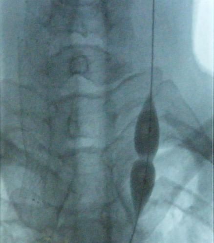 File:CCSVI balloon dilatation of stenosed jugular vein.jpg