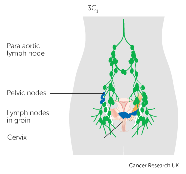 File:Diagram-showing-stage-3C1-cervical-cancer.png