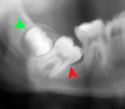 File:Impacted 2nd molar.png