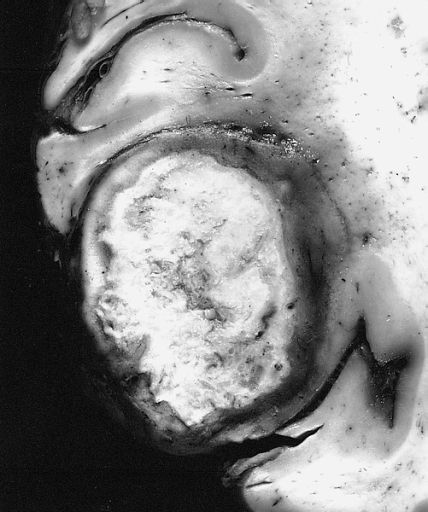 File:AFIP-00405562-GiantCellGlioblastoma-Gross.jpg