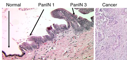 File:Pancreas neoplasia carcinoma sequence.png