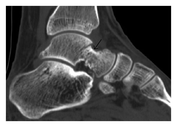 File:Subtle anterior talar fracture - CT.jpg